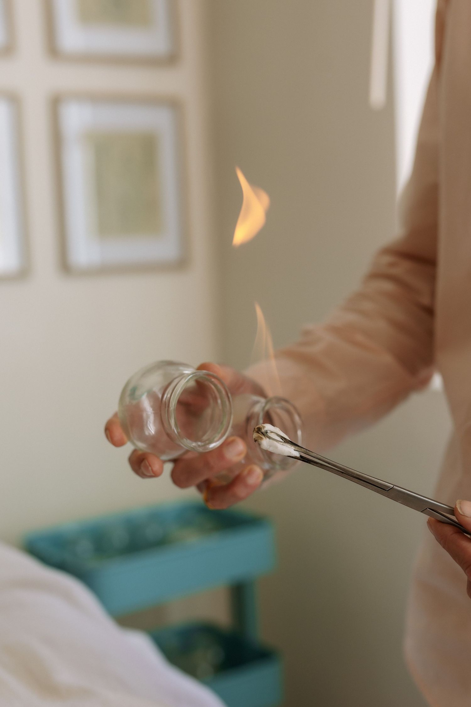 Practitioner performing fire cupping therapy, heating a glass cup with a flame using metal tongs in a treatment room.
