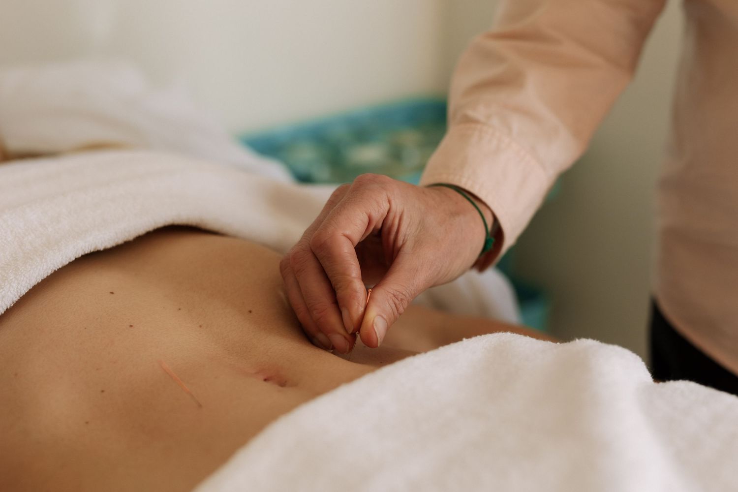 Acupuncturist inserting needles into a patient's lower back during a traditional acupuncture therapy session.