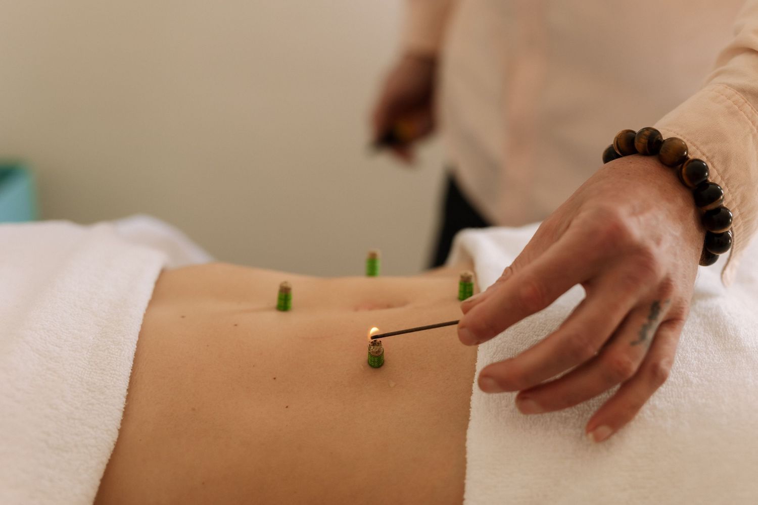 Acupuncturist inserting green-tipped needles into a patient's lower back during a therapeutic acupuncture session.
