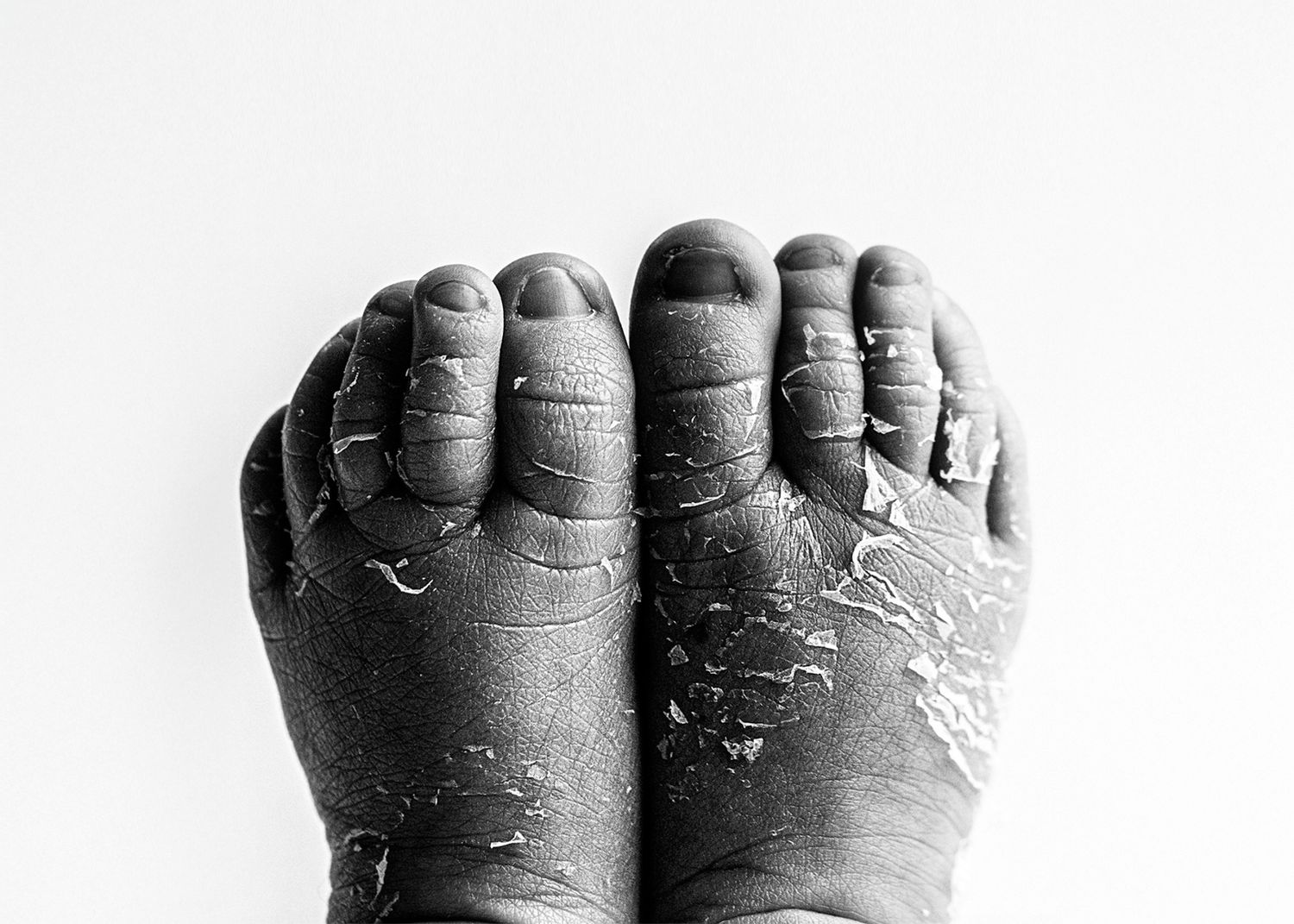 Close-up black and white photograph showing dry, cracked, and peeling skin on feet.
