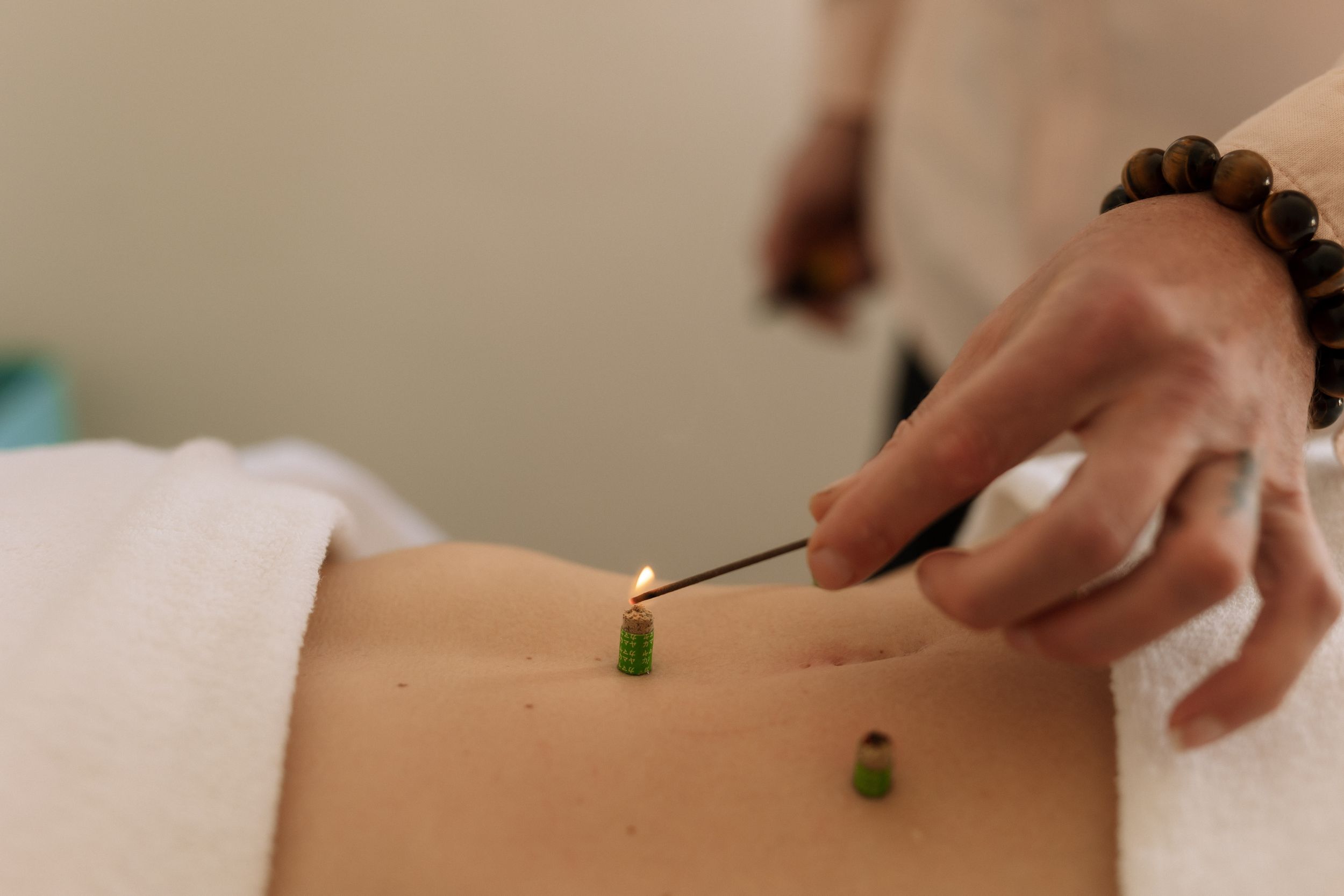 Acupuncturist lighting moxa sticks placed on a patient's back during moxibustion therapy.