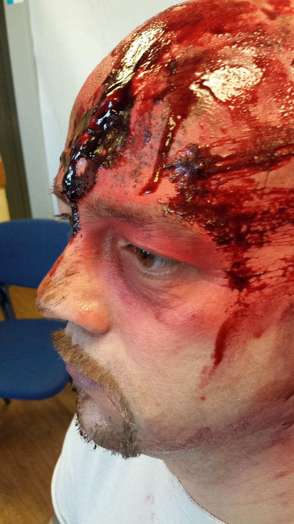 Victim has sustained injury from hitting the windsheild in an accident