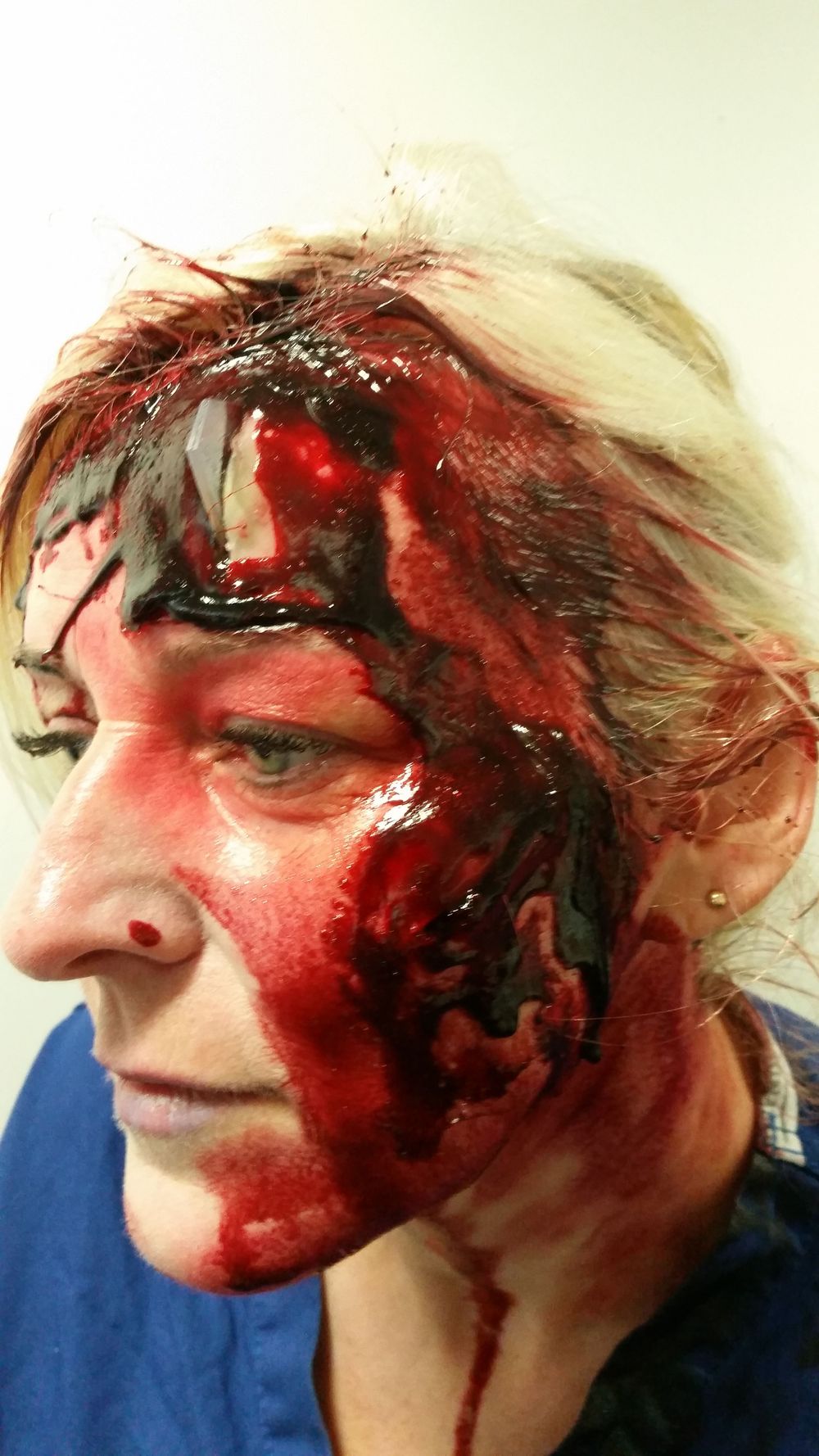 Frontal fracture and lacerations from RTA