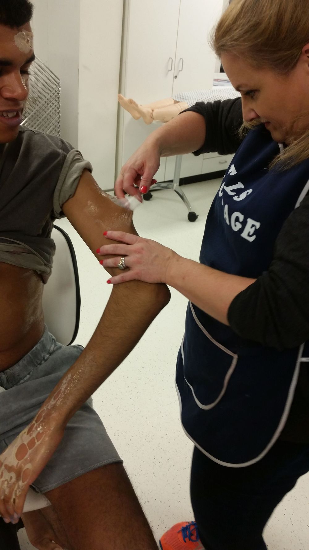 The burns being created