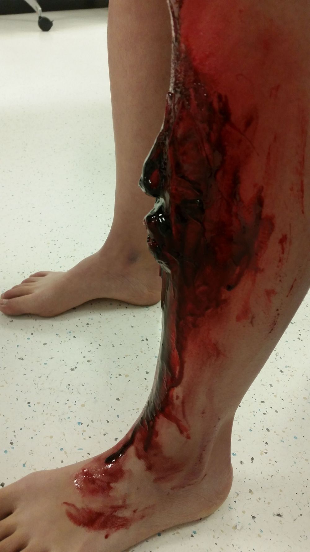 Open fracture of tibia