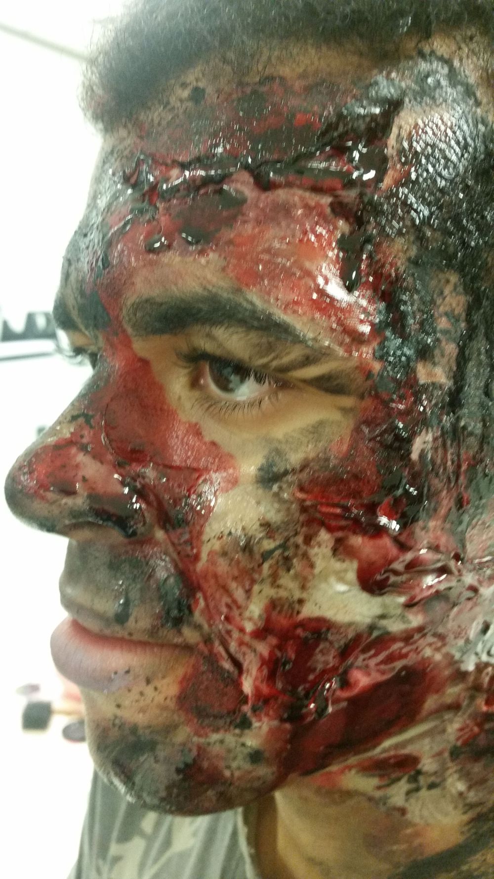 Facial burns
