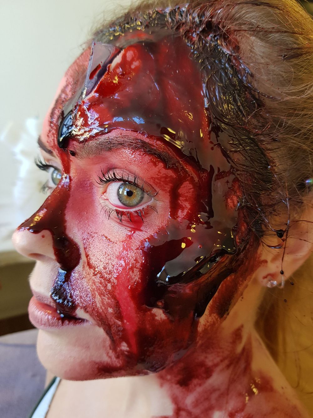 Frontal skull fracture