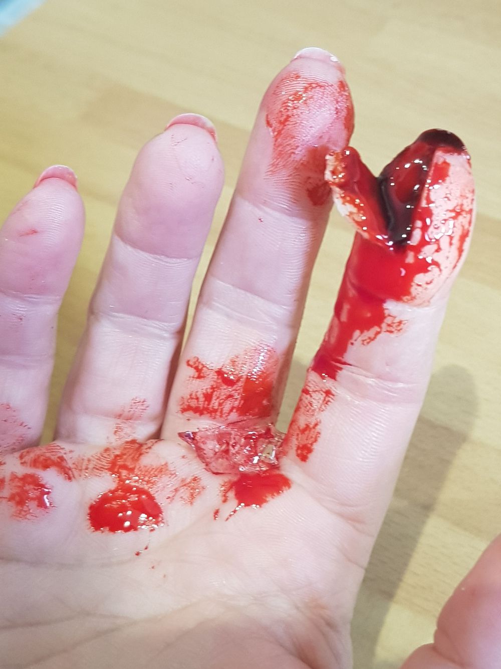 Tip of finger laceration