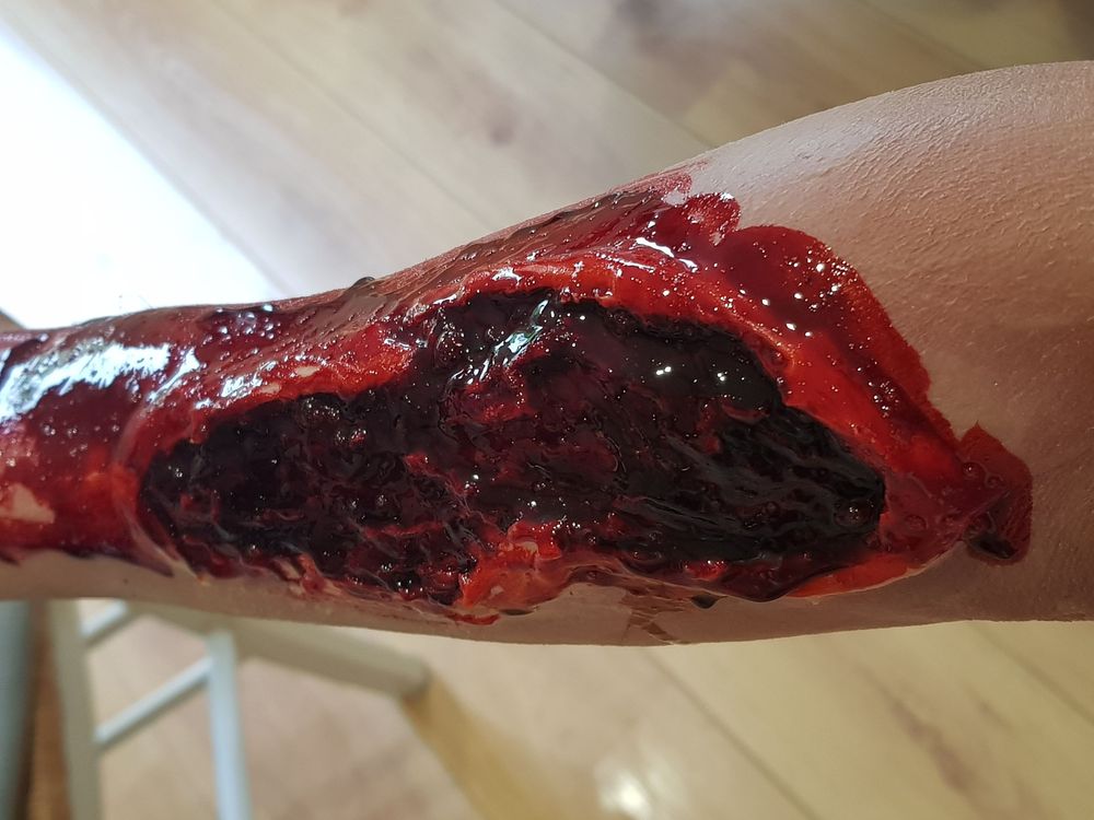 Deep chemical burn to arm