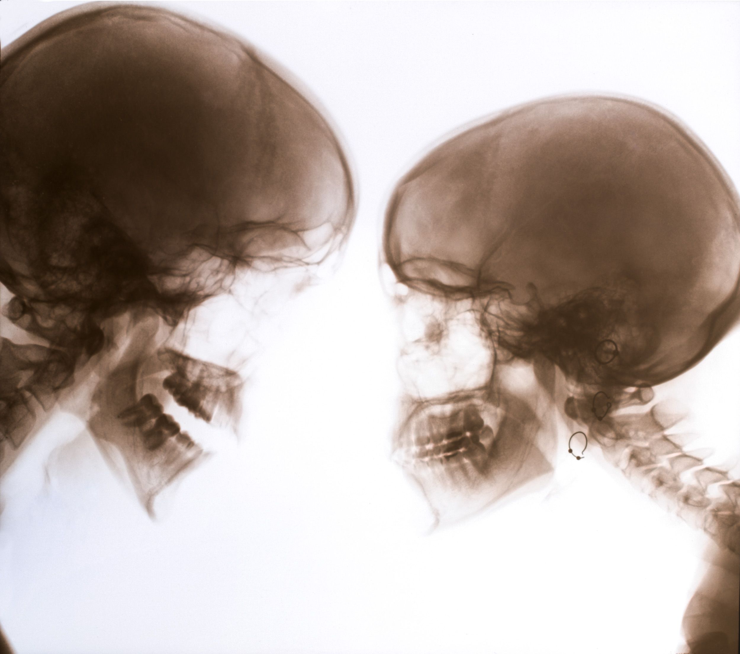 Series of medical x-ray images showing skull profiles in sepia tones.