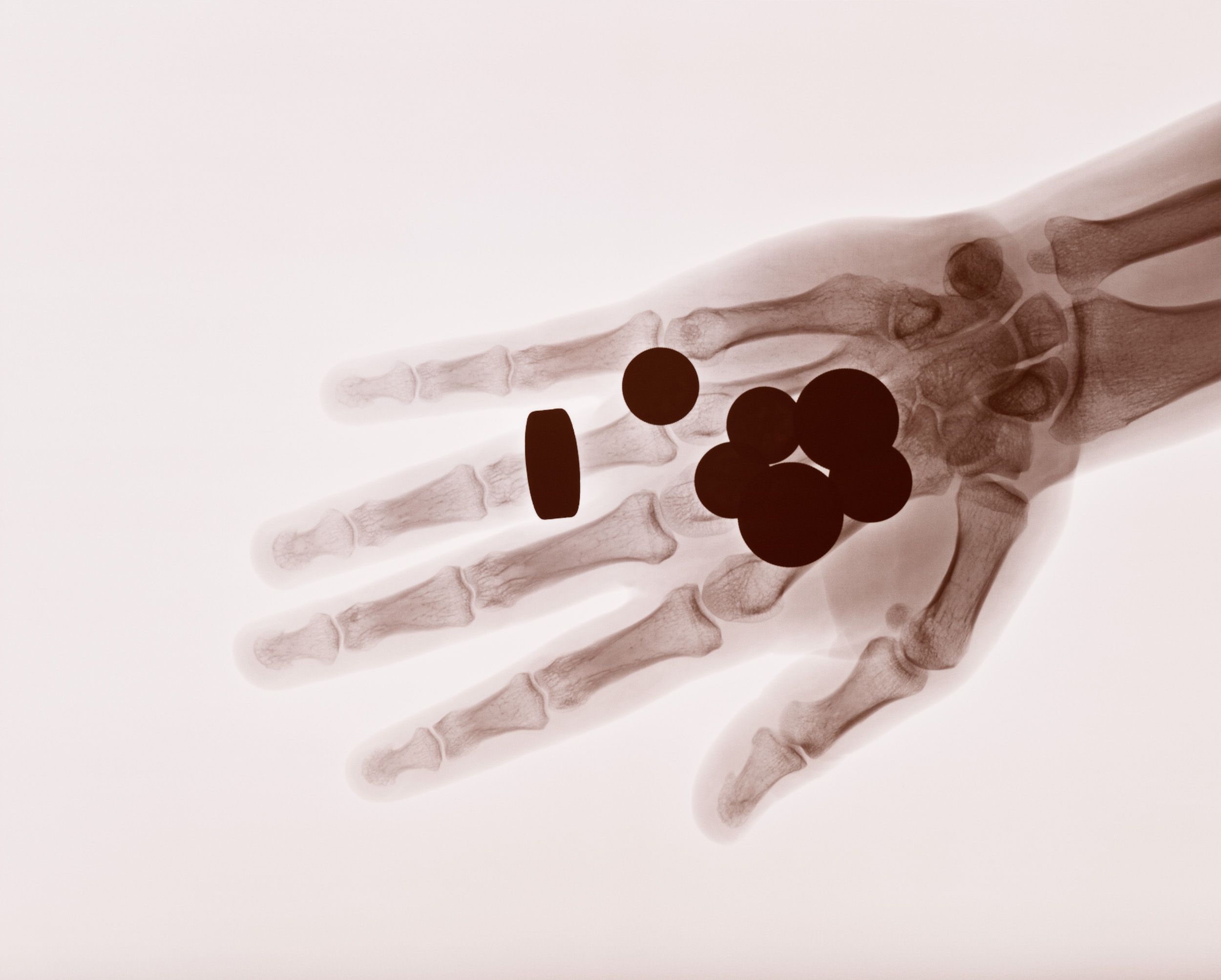 X-ray series showing skeletal structure of a human hand in sepia tones.