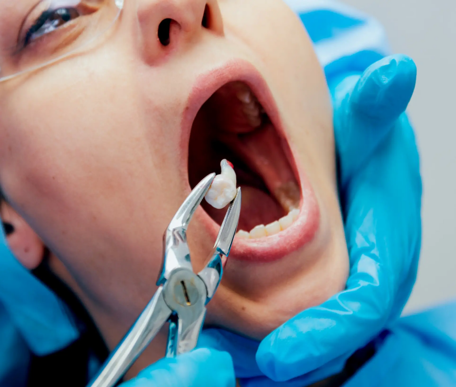 Tooth Extraction Cost in Dubai