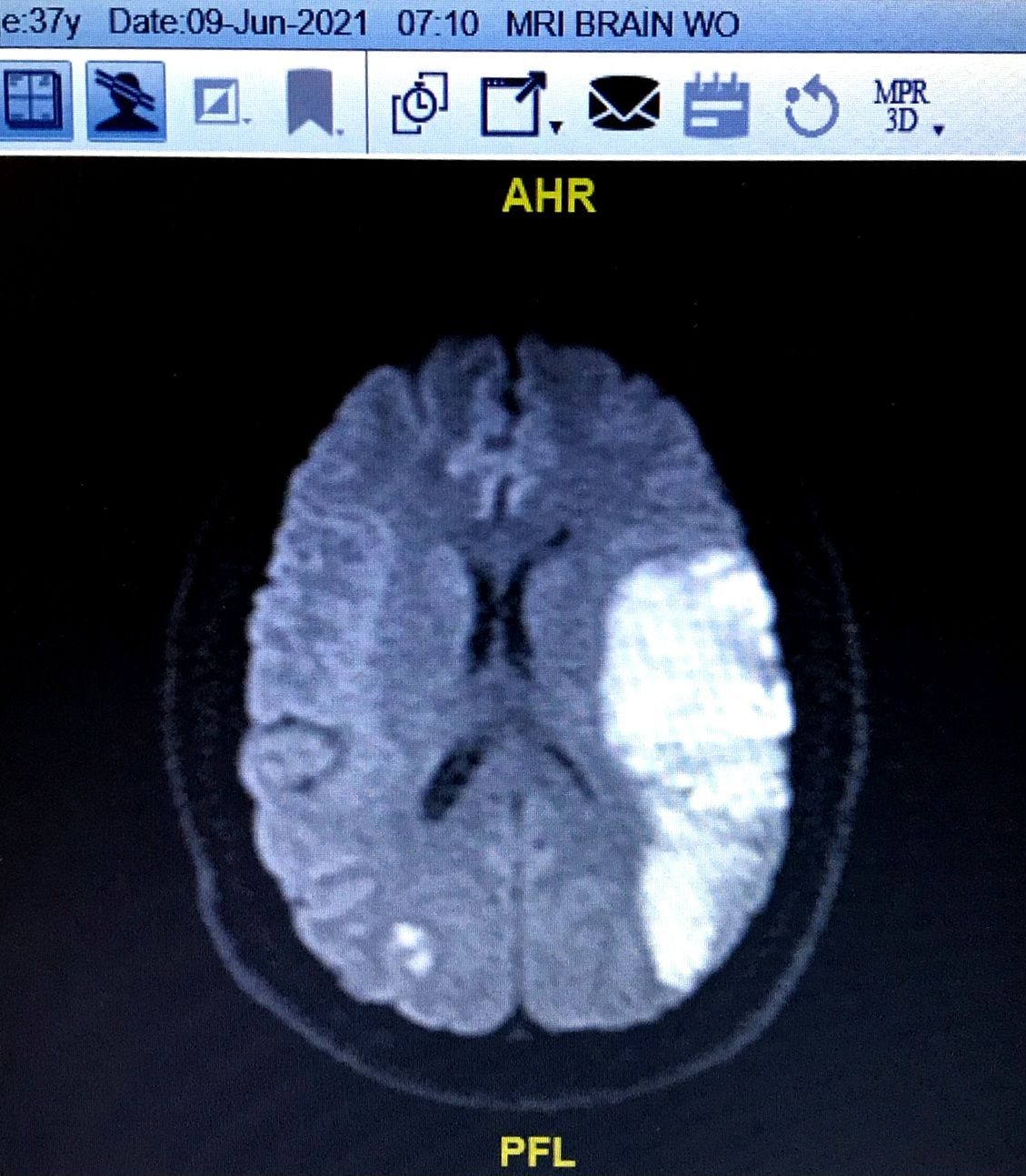 MRI brain scan showing a large bright area indicating acute hemorrhagic stroke in the left temporal-parietal region.