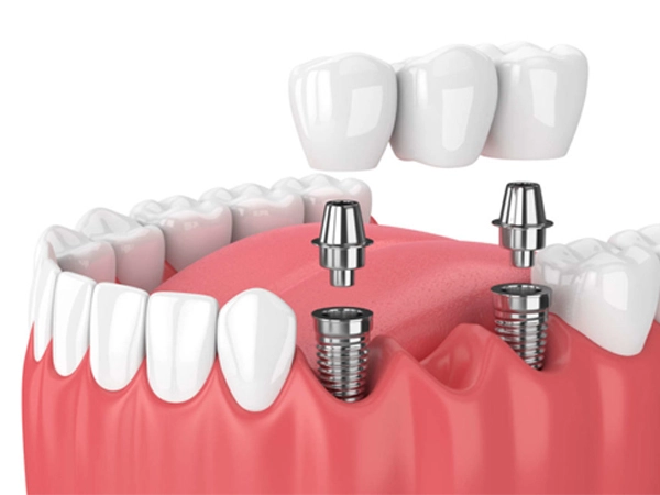 Dental Crowns and Bridges