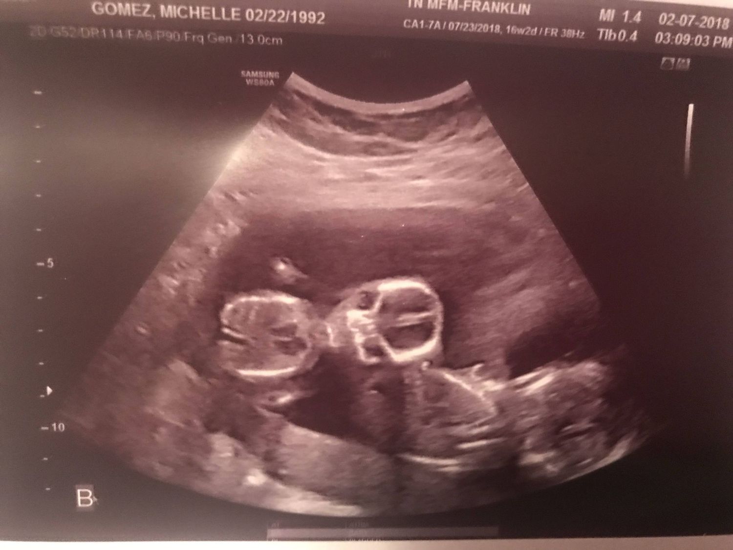 Medical ultrasound scans showing detailed views of fetal development.