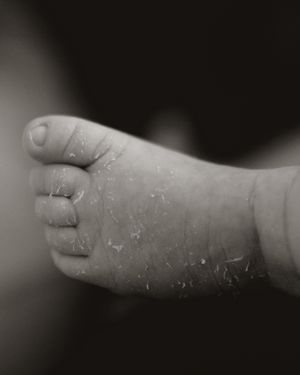 Close-up black and white photograph of a tiny baby's foot with peeling skin against a dark background.