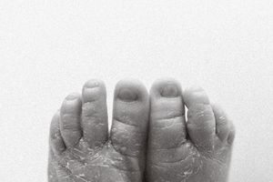 Black and white close-up photo of baby feet with dry, peeling skin on a white background.