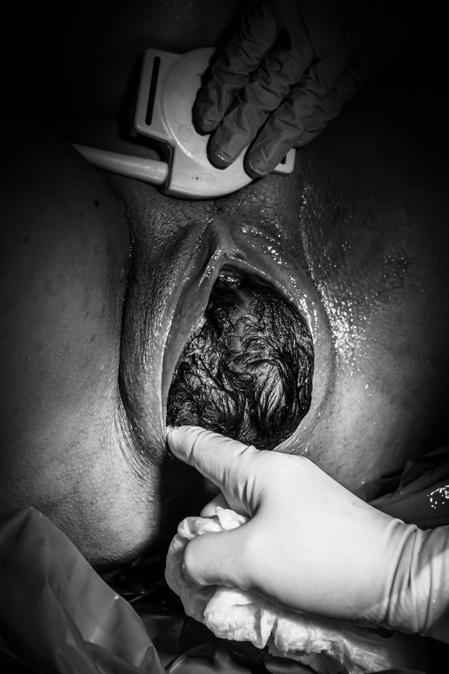 Veterinarian wearing gloves examines equine hoof during medical procedure in black and white photograph.