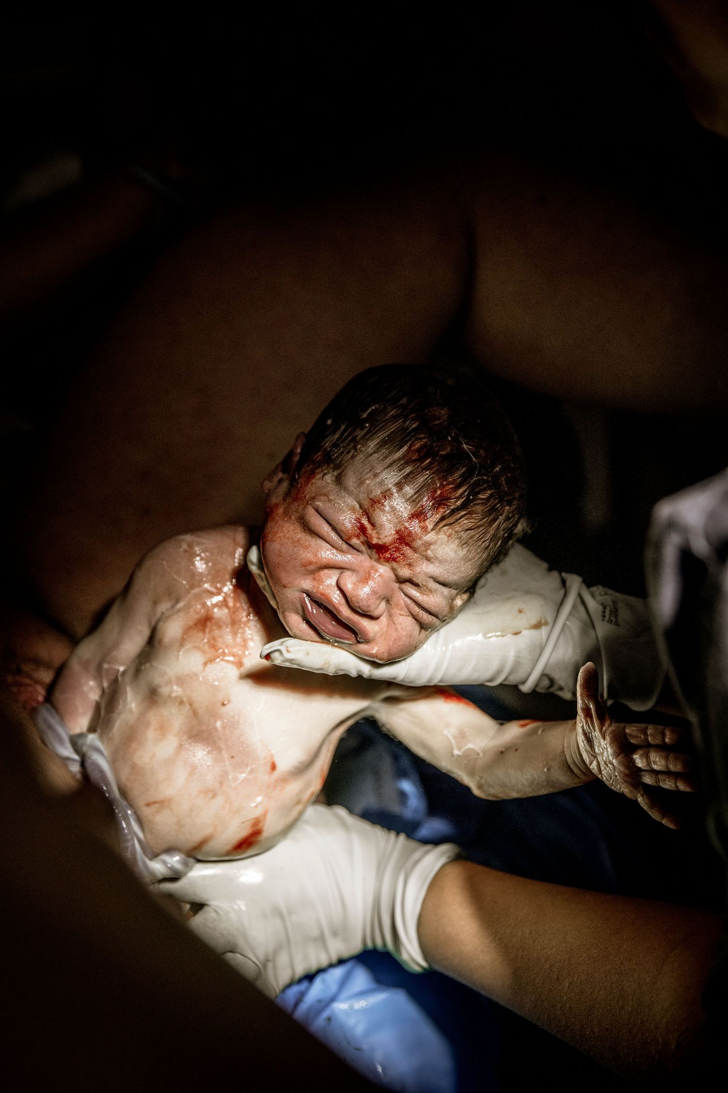 A newborn baby receives care immediately after birth with medical staff wearing gloves.