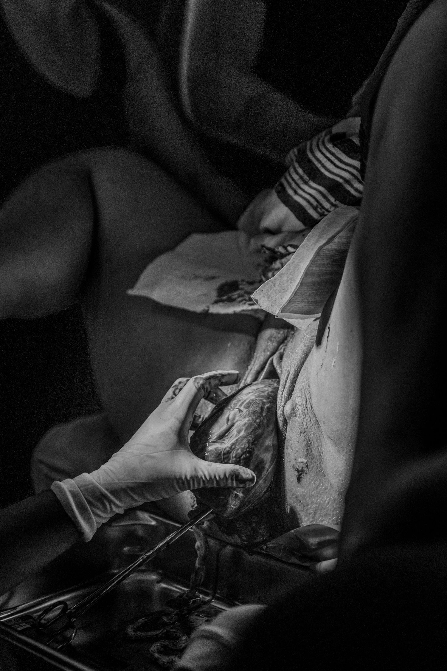 Black and white surgical image showing gloved hands performing an operation with medical instruments.