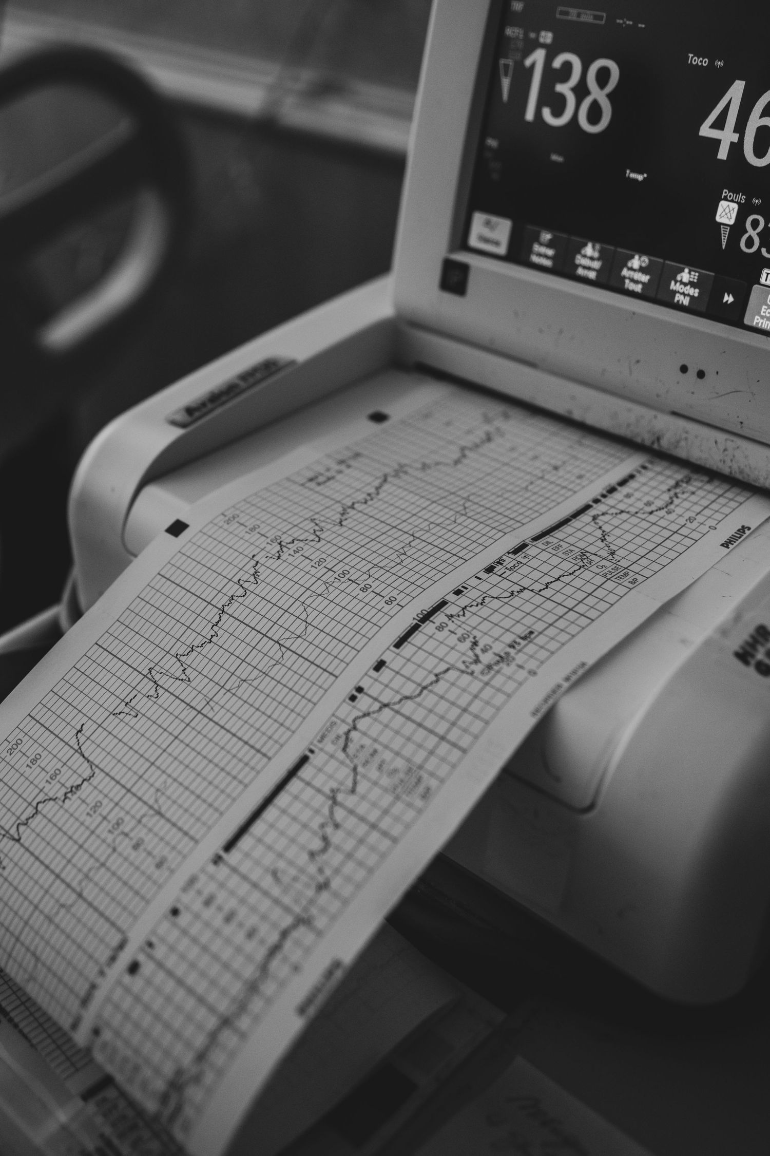 Medical monitor displaying vital signs with printed ECG heart rhythm strip paper readout in black and white.