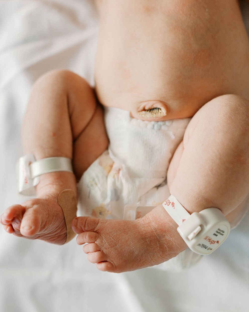 Close-up of newborn baby legs with hospital identification bracelet and umbilical cord clamp.