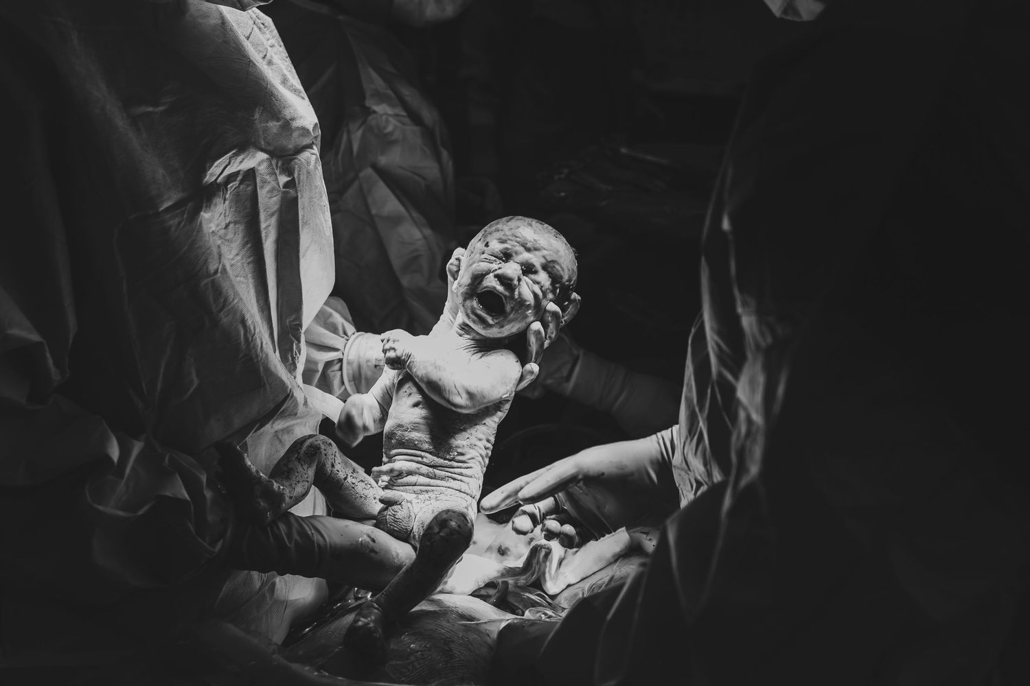 RBWH Birth C-Section Birth Photography Brisbane
