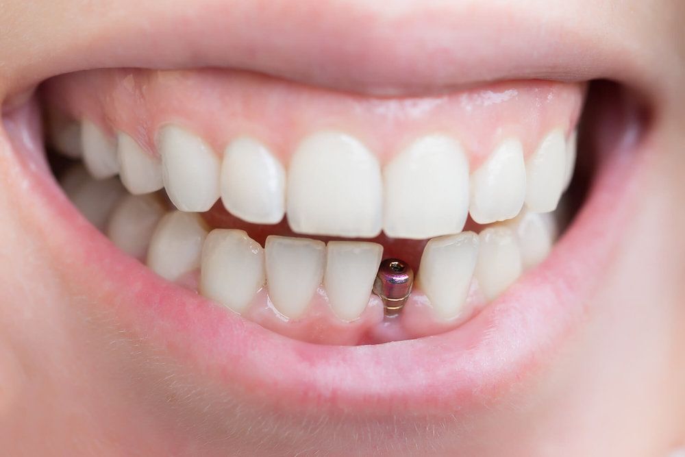 Dental Implants in Dubai