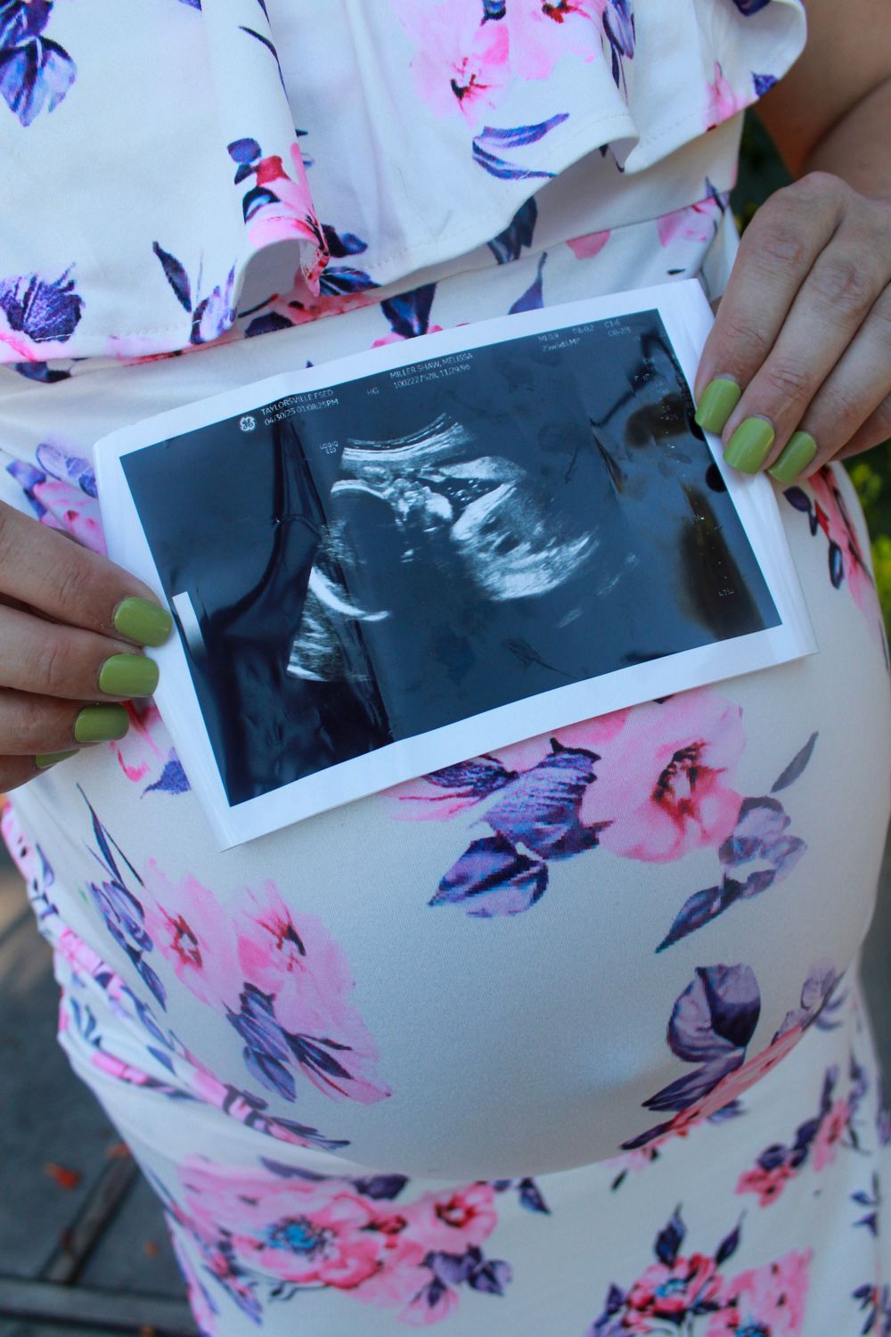 Ultrasound photos displayed against a floral patterned dress or fabric.