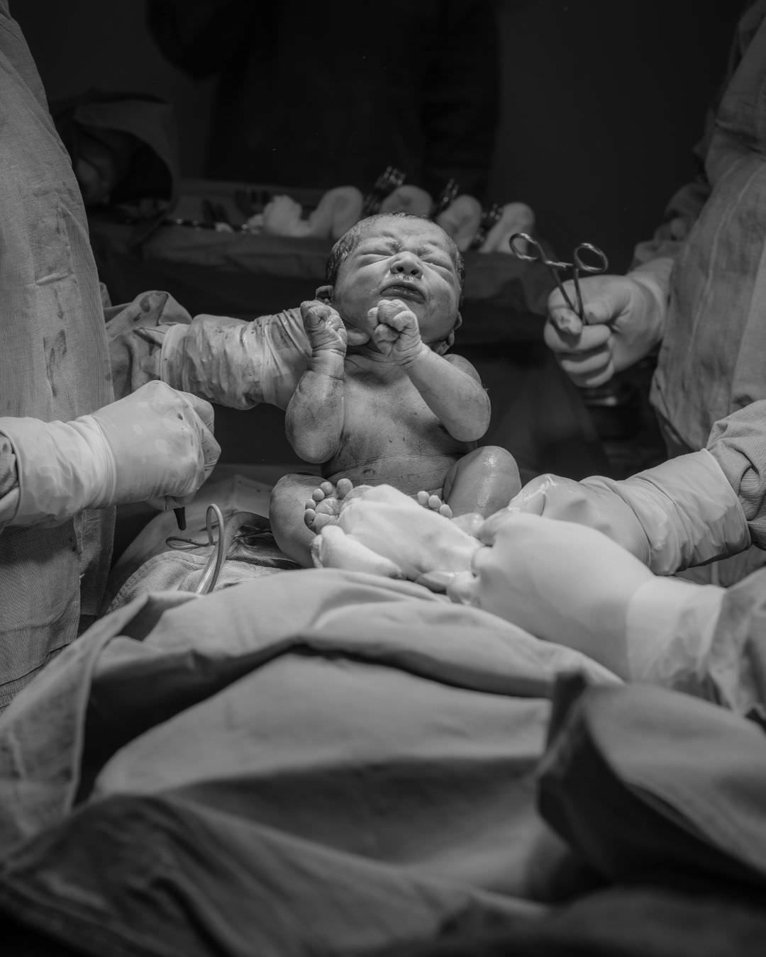 Geburtsfotografie Wiesbaden und Rhein & Main: Schwarz-Weiß-Fotografie eines neugeborenen Babys, das während einer medizinischen Untersuchung