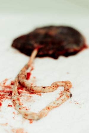 Close-up of a human placenta with umbilical cord on white surface after childbirth delivery.