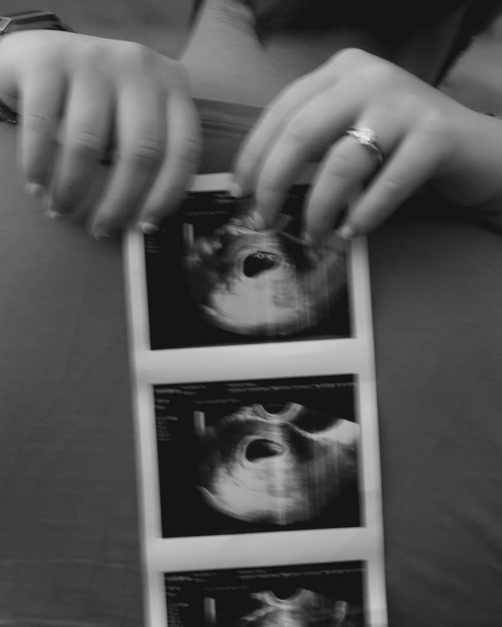 Multiple black and white ultrasound photos arranged in a sequence on a dark surface.