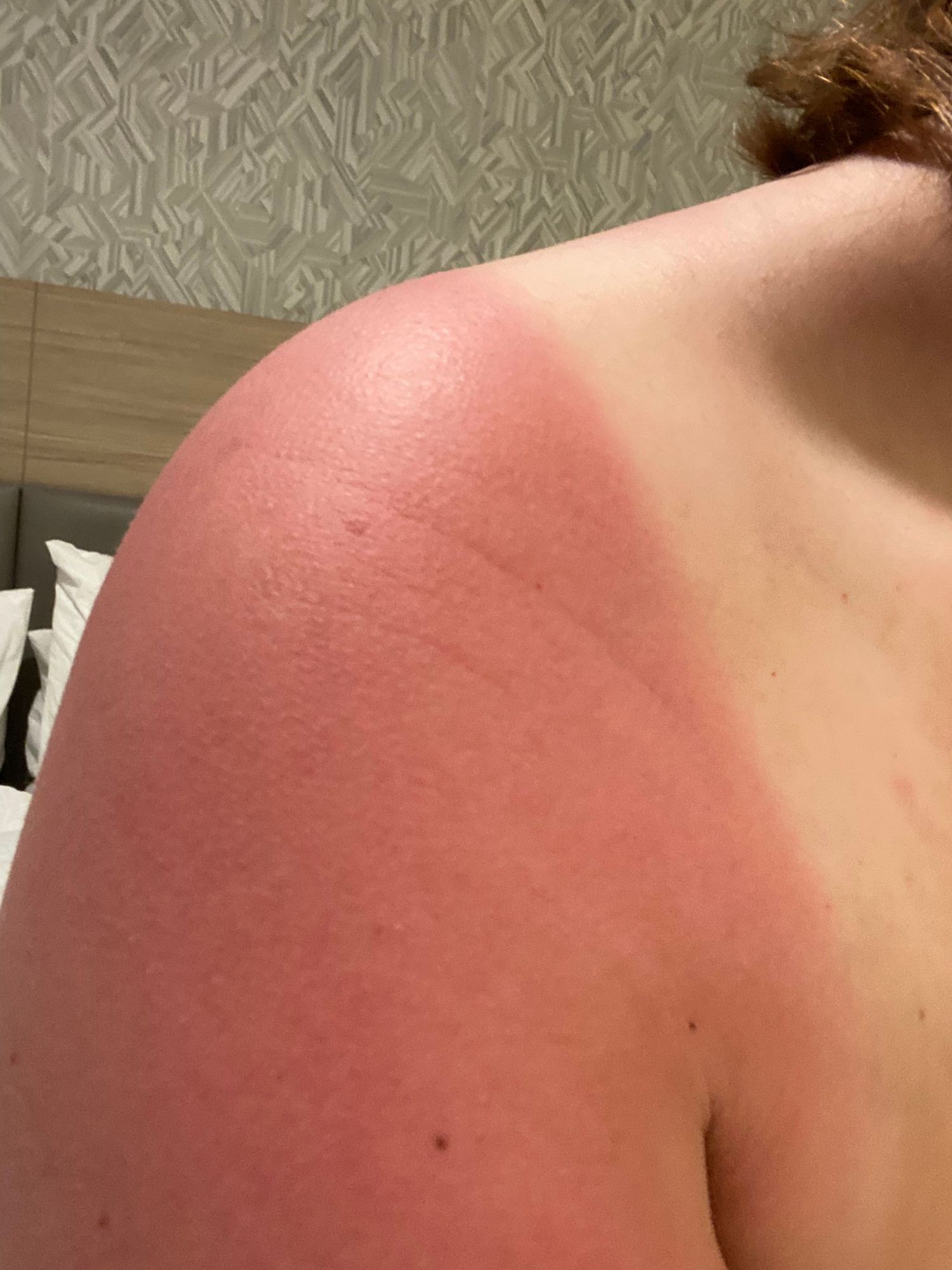 Severe sunburn shown on shoulder with clear tan line demarcation.