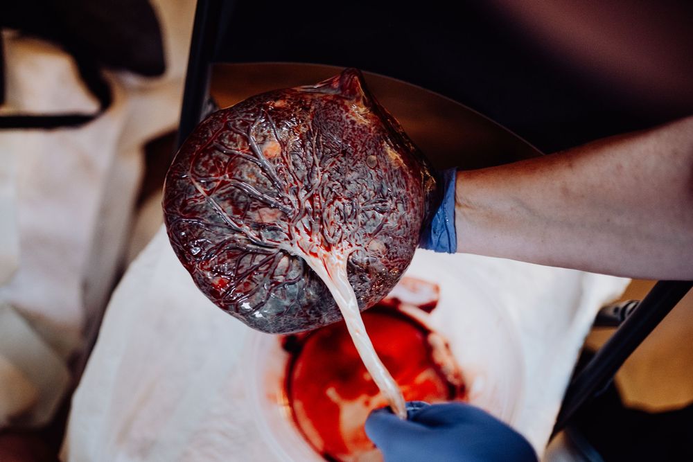 A gloved hand holds a freshly delivered human placenta showing intricate blood vessel patterns after childbirth.
