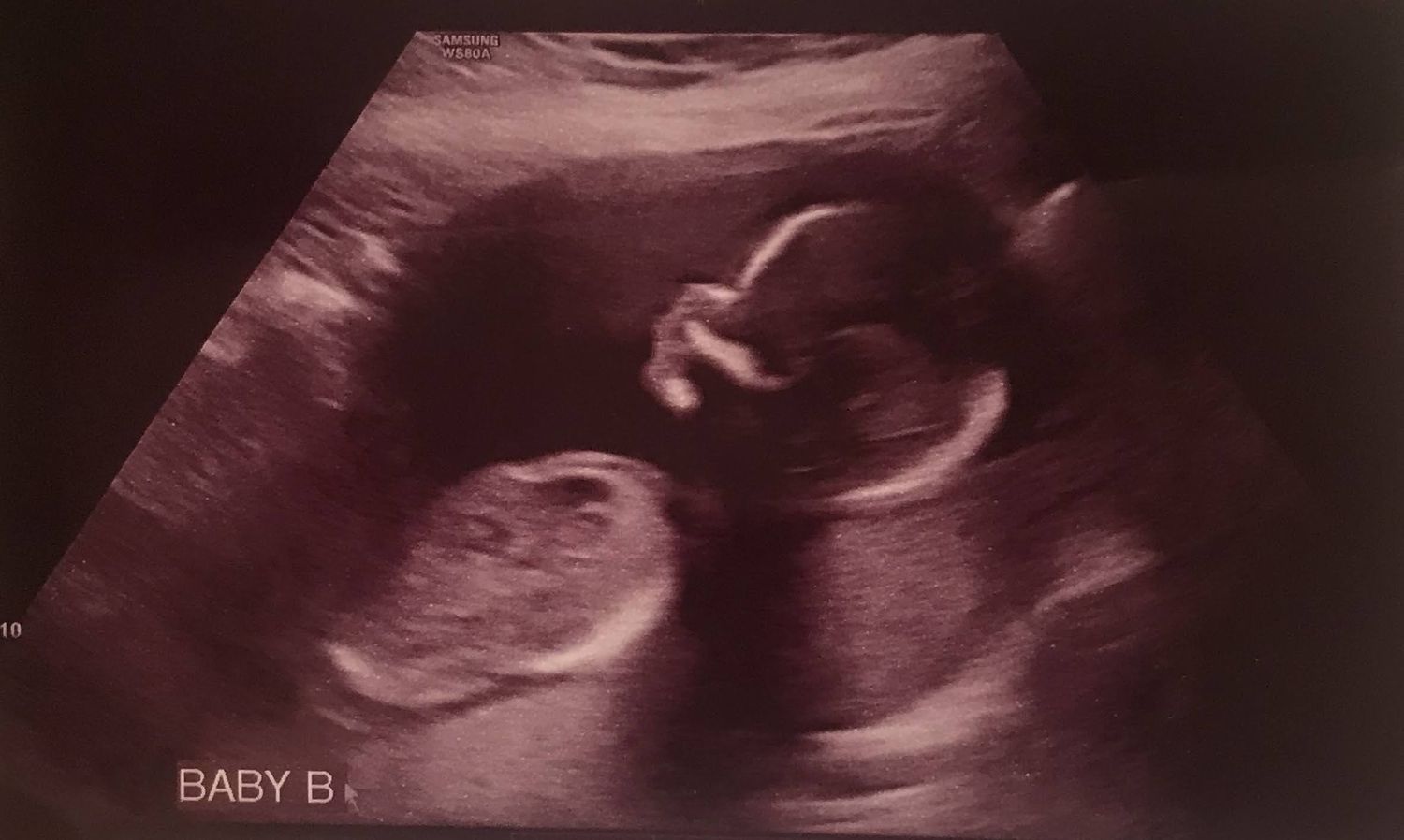 Multiple ultrasound images revealing different perspectives of prenatal development.