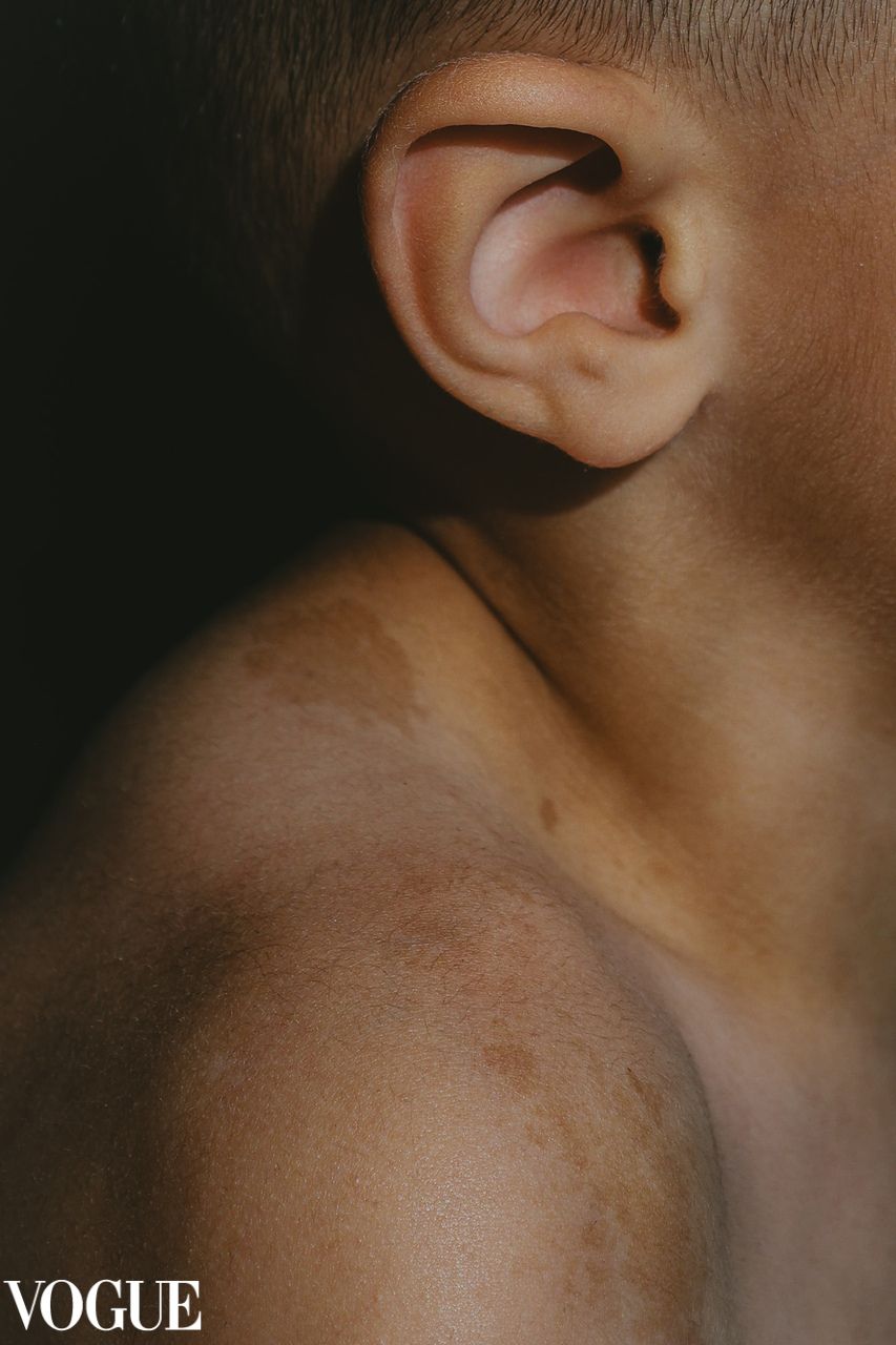 vogue, detail close up portrait of Childs birthmark on shoulder, grainy ,colour, natural light