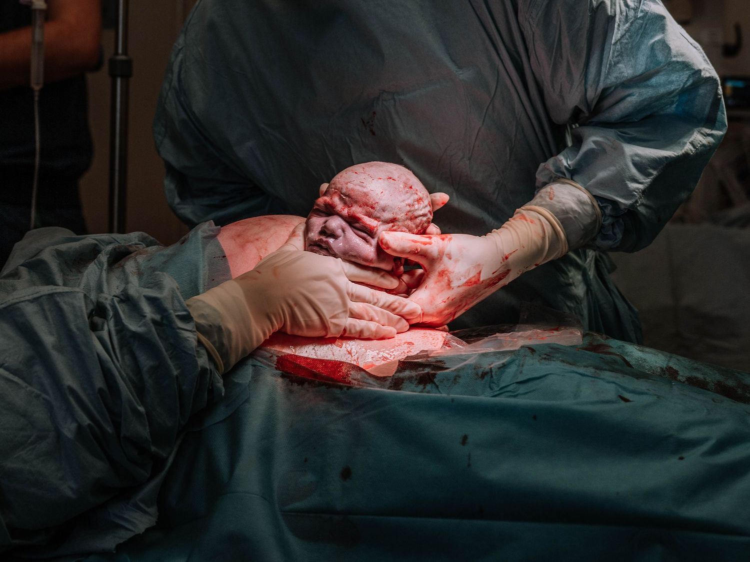 Surgeon performing a C-section delivery, carefully extracting a newborn during cesarean surgery in an operating room.