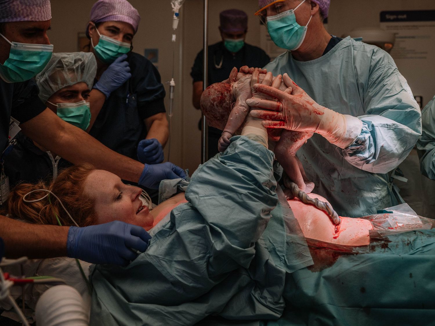 Medical team assists mother during childbirth in an operating room, with newborn baby being delivered by surgeons.