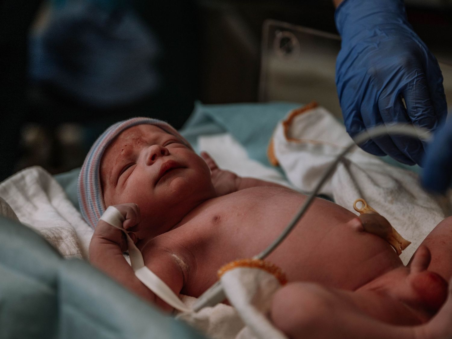 Newborn baby receiving medical care in hospital, with oxygen tube and monitoring equipment attached.