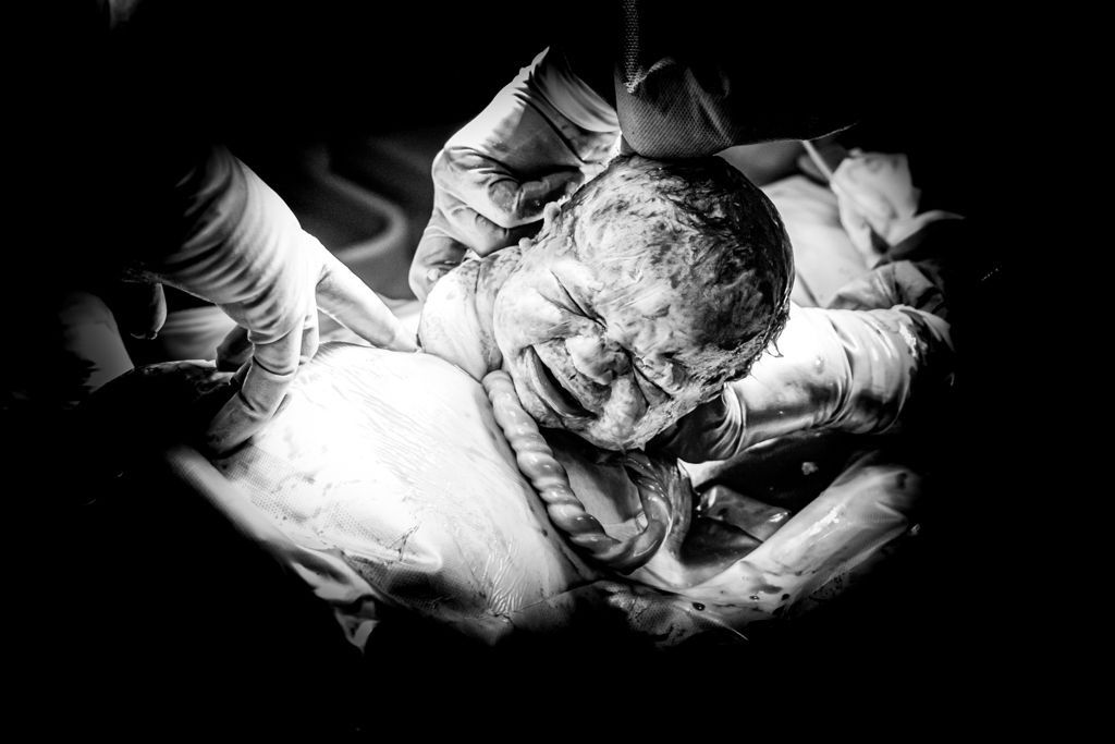 black and white image of baby and umbilical cord halfway out of womb during c-section