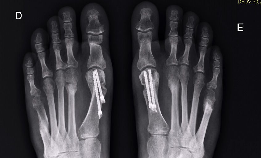 X-ray of both feet showing surgical screws in the first metatarsal bones, indicating bunion correction surgery.
