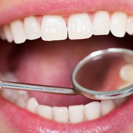 Tooth Fillings for Permanent Teeth Longevity in Dubai Dynamic Clinic