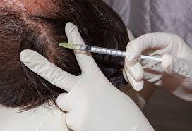 Hair Transplant
