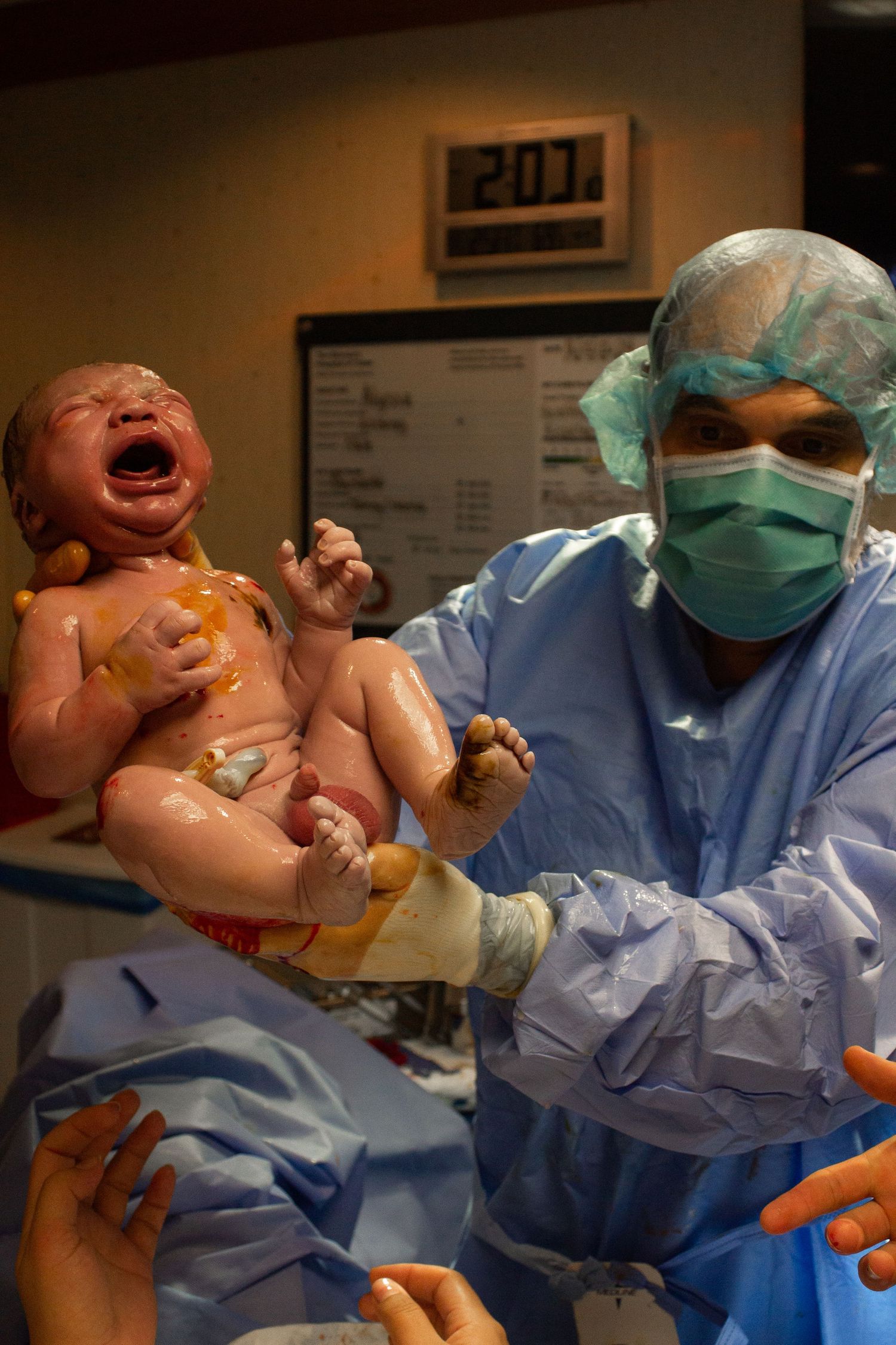 Newborn baby crying during first moments after birth with medical staff in scrubs.