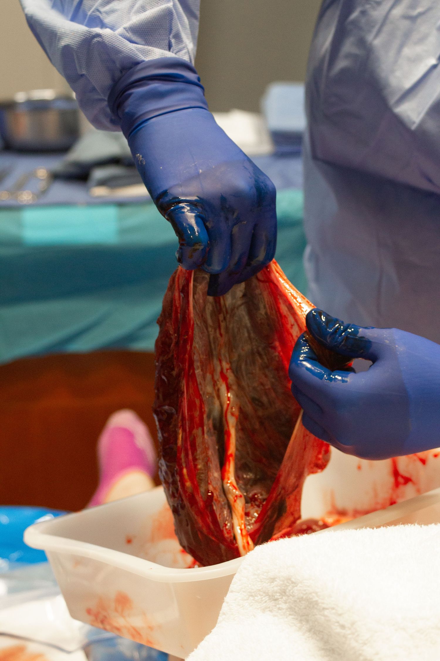 Medical professional in blue gloves handling placenta tissue during post-birth procedure.