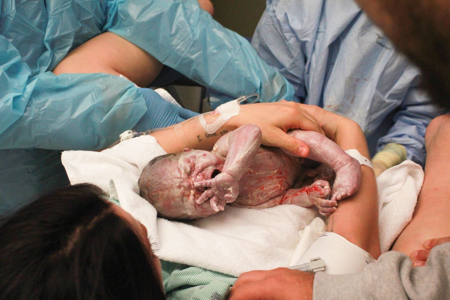 Medical professionals support a newborn immediately after birth in a hospital delivery room.