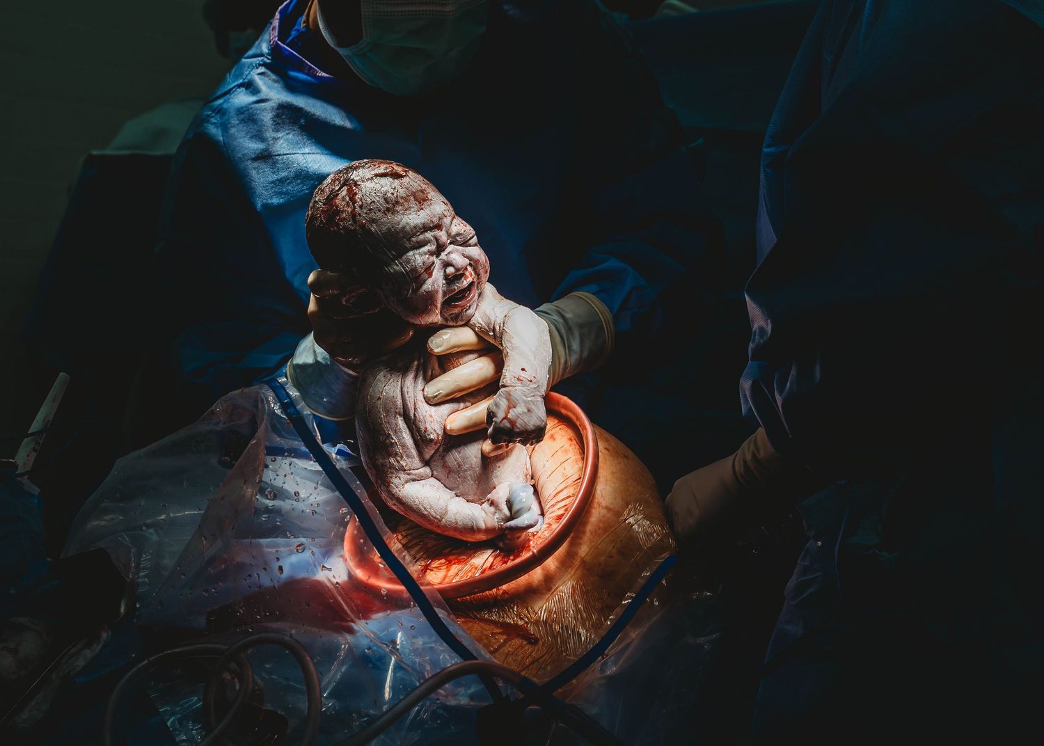 Newborn baby held up by a gloved doctor during a cesarean delivery, lit by a warm orange glow in a dark operating room. Taken by Keely King