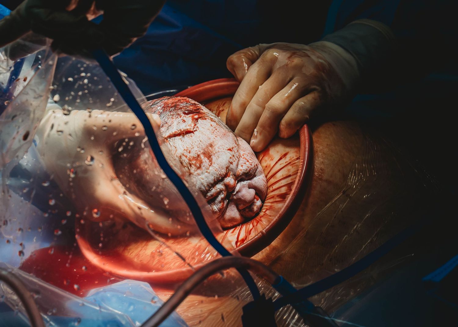 Surgeons performing open heart surgery with gloved hands visible and exposed cardiac tissue during a medical procedure.