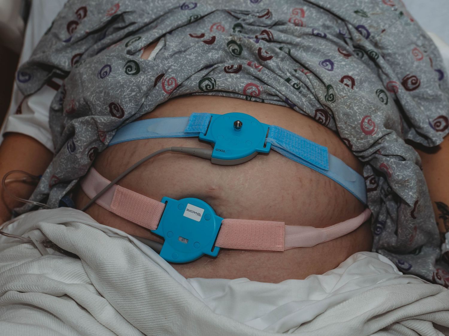 Pregnant woman's abdomen with two fetal monitoring belts and blue sensors strapped on during labor or a prenatal non-stress test.