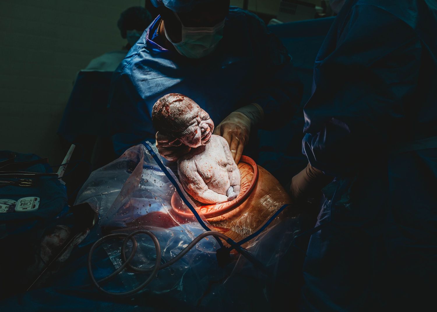 Newborn baby being delivered by cesarean section in an operating room by medical professionals in scrubs taken by Keely King Photography.
